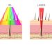 Depilación láser y depilación IPL